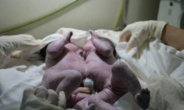 Phẫu thuật thành công ca sinh đôi dính chặt gan