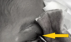 Cứu sống ngoạn mục bé trai bị thanh sắt đâm xuyên não