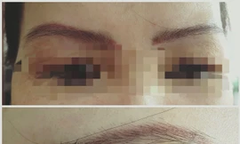 Người phụ nữ nguy kịch sau xăm lông mày đã tử vong