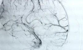 Nôn ói cứ ngỡ trúng thực, bệnh nhân suýt chết vì xuất huyết não