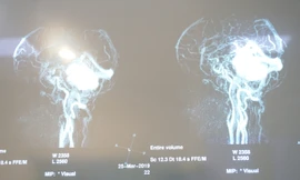 15 giờ căng thẳng cứu sống bệnh nhân u não nhiều nơi từ chối điều trị