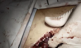 Bé trai 13 tuổi bị thanh sắt đâm thấu ngực khi đi cắt lúa 