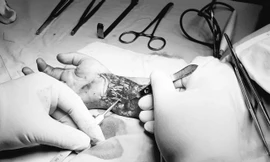 Đang tắm gặp tai nạn bất ngờ, bé trai 6 tuổi đứt gần lìa bàn tay