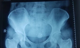 Gắp thành công vòng tránh thai ‘đi lạc’ trong bàng quang nữ bệnh nhân