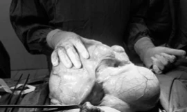 Người phụ nữ mang khối u hơn 6kg trong bụng nhưng không hay biết