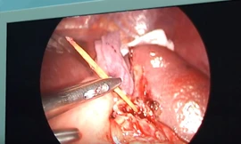 Người đàn ông bị thủng lá lách vì ngậm tăm đi ngủ