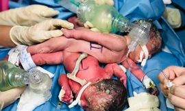 Mổ sinh thành công cho 2 bé gái song sinh dính liền, chỉ có một hậu môn