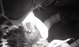 Lấy thành công khối đa nang lách dài nửa mét trong bụng người phụ nữ