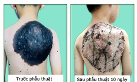 Phẫu thuật thành công “mai rùa” trên lưng bé trai 7 tuổi