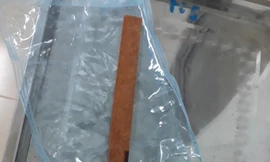 Lấy thành công mảnh gỗ nửa mét “đi lạc” vào ngực người thợ mộc