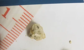 Ăn mặn, ít uống nước là đang ‘nuôi’ sỏi niệu