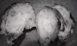 Bé trai có khối bướu to như quả bưởi trên mặt