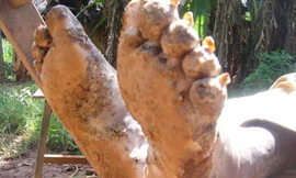 Căn bệnh quái ác biến người thành… thây ma sống