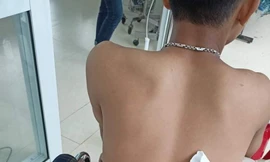 Nam thanh niên bị thanh cây keo đâm xuyên người. Ảnh: (FaceBook)