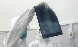 Kiểm tra phim chụp Xquang phổi cho bệnh nhân mắc COVID-19. Ảnh: TS -BS Lương Quốc Chính