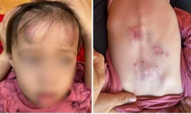 Những vết bầm tím của bé gái bị đánh ở lớp mầm non đăng tải trên mạng xã hội. 