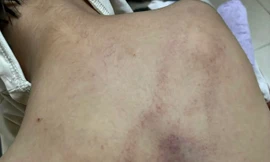 Bé mẫu giáo bị đánh tím lưng, clip từ camera khiến phụ huynh bàng hoàng