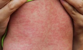 Nguy cơ bùng phát dịch sởi, Bộ GD&ĐT chỉ đạo khẩn