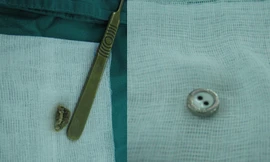 Nghịch dại, nhiều trẻ nhét đủ thứ đồ vào "vùng kín"