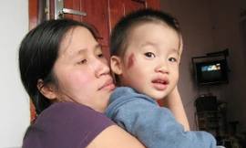 Cháu Nguyễn Quang Huy bị đánh trên mặt