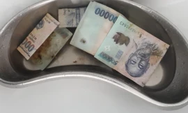 Hy hữu: Mâu thuẫn gia đình, người phụ nữ nuốt 12,5 triệu đồng vào bụng