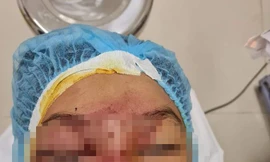 Mẹ bơm xe bị nổ lốp, mảnh vỡ làm hỏng mắt con trai