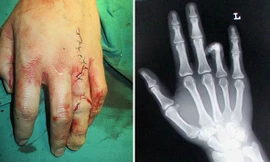 Ghép ngón chân vào bàn tay để... dễ xin việc