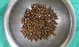 Số sỏi bác sĩ lấy ra từ túi mật của bệnh nhân 60 tuổi ảnh: TH 