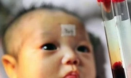 Phát hiện nguy cơ Down ở trẻ qua xét nghiệm máu