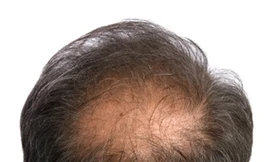 Kích thích nang tóc để chữa hói đầu