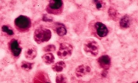 Thêm ba người chết do amip ăn não