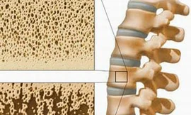 Loãng xương "kẻ ăn cắp” giấu mặt