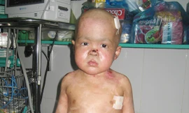 Lần đầu ghép tủy ca bệnh hiếm gặp