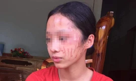 Bênh em gái, nữ sinh lớp 8 bị cào sưng mặt