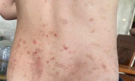 Hàng trăm người ở Hà Tĩnh bị côn trùng đốt gây sẩn ngứa