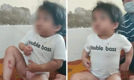 Bác sĩ báo công an sau khi bé 4 tuổi nhập viện với nhiều vết thương đáng ngờ
