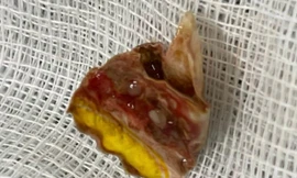 Ho ra máu suốt 2 năm vì nguyên nhân bất ngờ