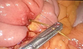 Thủng ruột, sốc nhiễm trùng vì xương cá