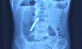 Bé trai 2 tuổi thủng ruột vì món đồ chơi nhiều trẻ em mê mẩn