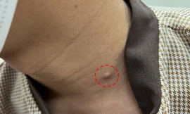 Mụn lâu lành biến thành ung thư