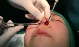 Nâng mũi trong khách sạn, 2 phụ nữ bị tai biến và trộm cắp tài sản