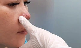 Mũi miệng bầm tím, mặt biến dạng sau tiêm chất làm đầy tại spa