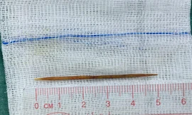 Bệnh nhi bị thủng nhiều lỗ trong nội tạng vì chiếc tăm xỉa răng