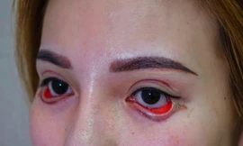 Cắt mí thành 'đôi mắt quỷ', cô gái trẻ bị cho thôi việc