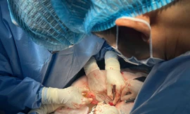 Cảnh báo tử vong vì vỡ túi phình động mạch chủ bụng