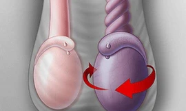 Bé trai 3 tuổi mất tinh hoàn vì cha mẹ trì hoãn phẫu thuật