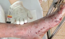 Bệnh nhân bong da toàn thân vì loại vi khuẩn nguy hiểm kháng thuốc
