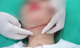 Cô gái nhập viện với vết cắt dài 15cm trên cổ