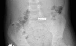 Bé gái giấu 5 viên bi nam châm vào… ruột non