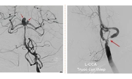 Người phụ nữ bị cùng lúc 2 dạng đột quỵ đặc biệt nguy hiểm